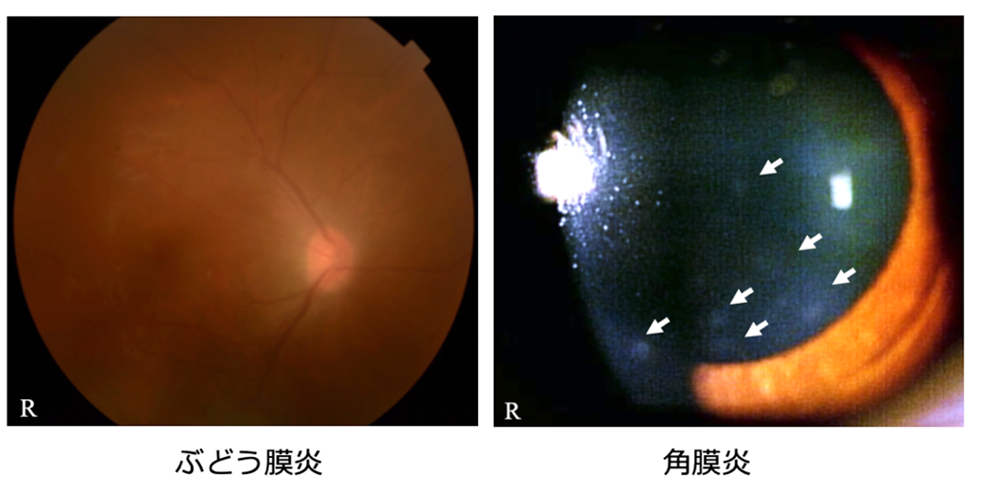 図2HTLVー1の水平感染によって発症したHTLV-1ぶどう膜炎とHTLV-1角膜炎.png